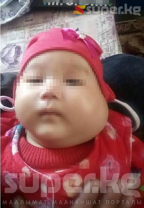 Айдиана 2 айлык кезинде. Ушул учурда шишик тездик менен чоңойгон