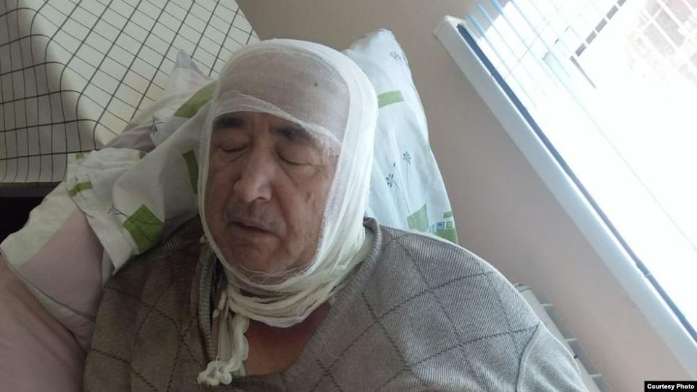 Кызын сактайм деп күйүк алган атасы учурда ооруканада дарыланууда.